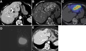 Radioembolization, Y-90 Alamogordo