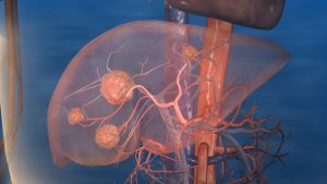 Radioembolization, Y-90 Alamogordo